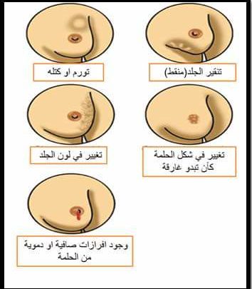 ماهي اعراض مرض الثدي - كيف تتاكدى من سلامة ثديك 628 6