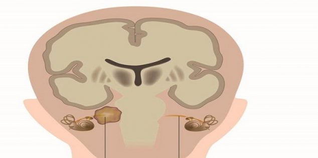 اعراض ورم العصب السمعي - اعراض الورم الشيفاني الدهليزي 2149