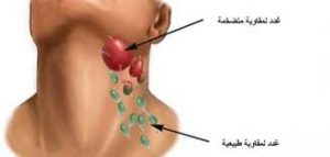 علاج التهاب الغدد اللمفاوية , من اخطر الامراض ماهي وما علاجها