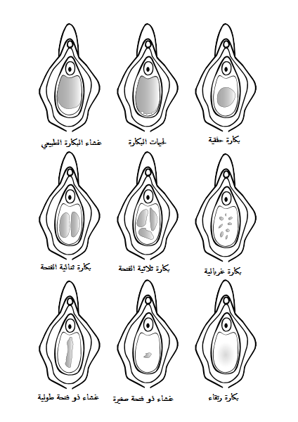 انواع غشاء البكارة - غشاء البكارة وتعدد انواعه 3677