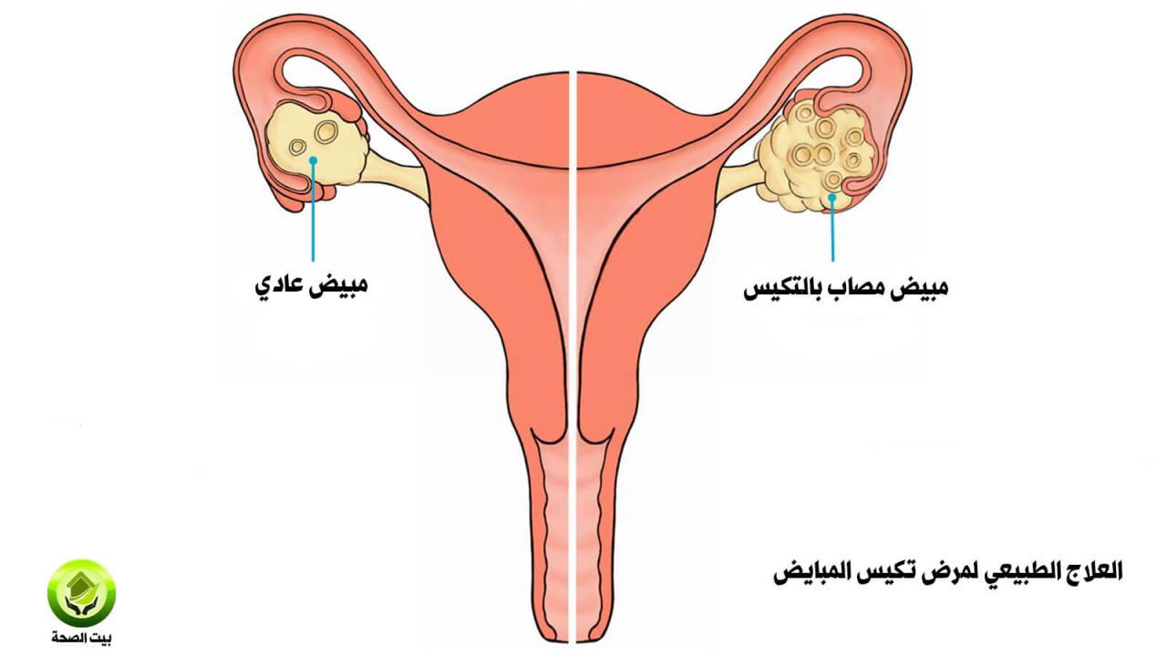 اعراض التكيس الشديد , اعرف ازاى عندى تكيسات ولا لا