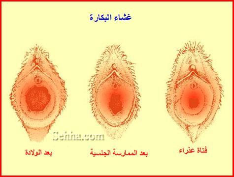 انواع غشاء البكارة - غشاء البكارة وتعدد انواعه 3677 2