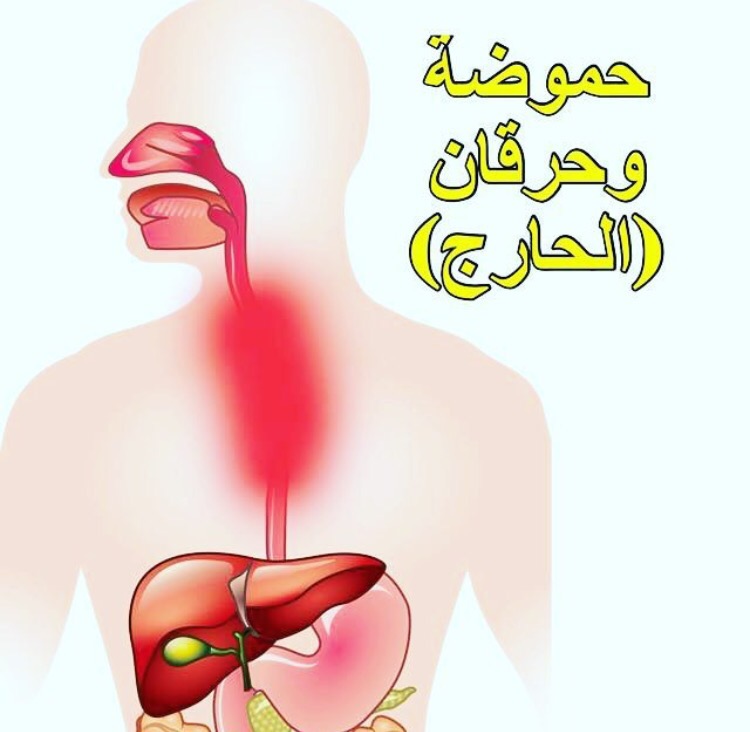 ماهو علاج حرقان المعده - تخلص من حرقان المعدة المزعج 3395 2