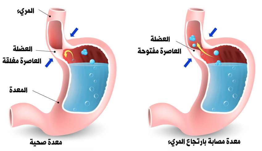 ماهو علاج حرقان المعده - تخلص من حرقان المعدة المزعج 3395 3