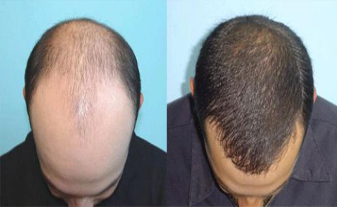 زراعة الشعر بالاقتطاف , الحل الامثل لمشاكل الصلع والشعر الخفيف