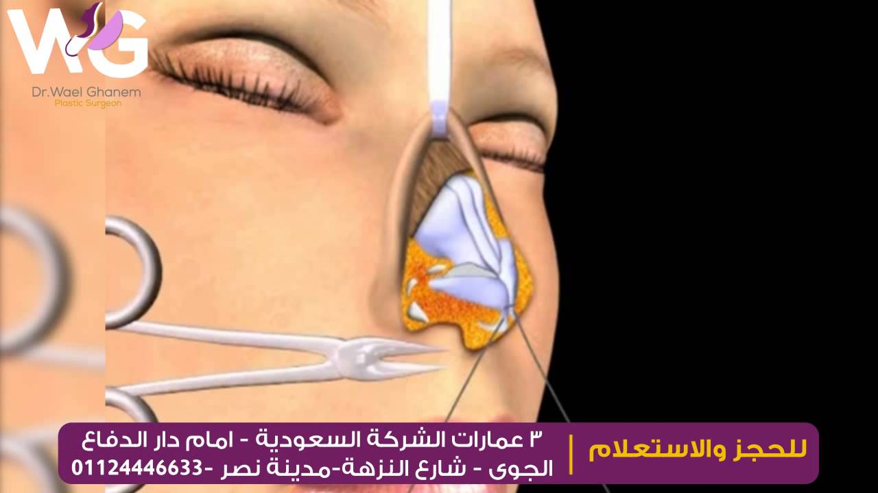 بعد عملية تجميل الانف بشهر , مر شهر علي العمليه ما النتيجه