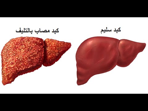 التليف الكبدي اسبابه وطرق العلاج , ما هو تشمع الكبد