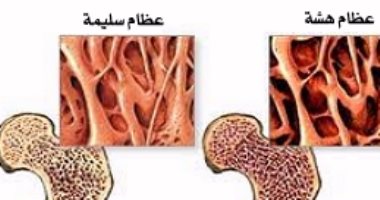 أهم أعراض وأسباب هشاشة العظام - اسباب هشاشة العظام 1485 1