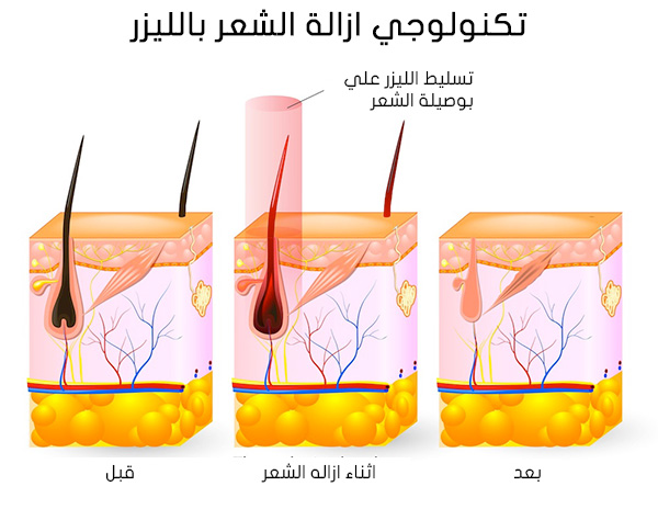 تفتيح منطقة البكيني بالليزر - التخلص من سواد البكيني باستخدام الليزر 2362 2