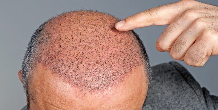 معلومه مهمه اذا زرعت شعر , متى يظهر الشعر المزروع