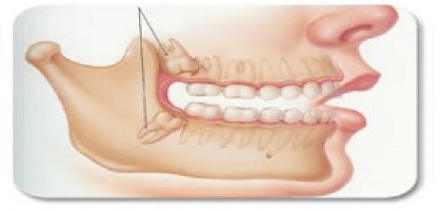 مكان ضرس العقل فى الفم - كيف اعرف ضرس العقل 4037 1