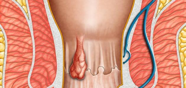 مرض وجعه فظيع تعرف علي سببه , اسباب البواسير وعلاجها