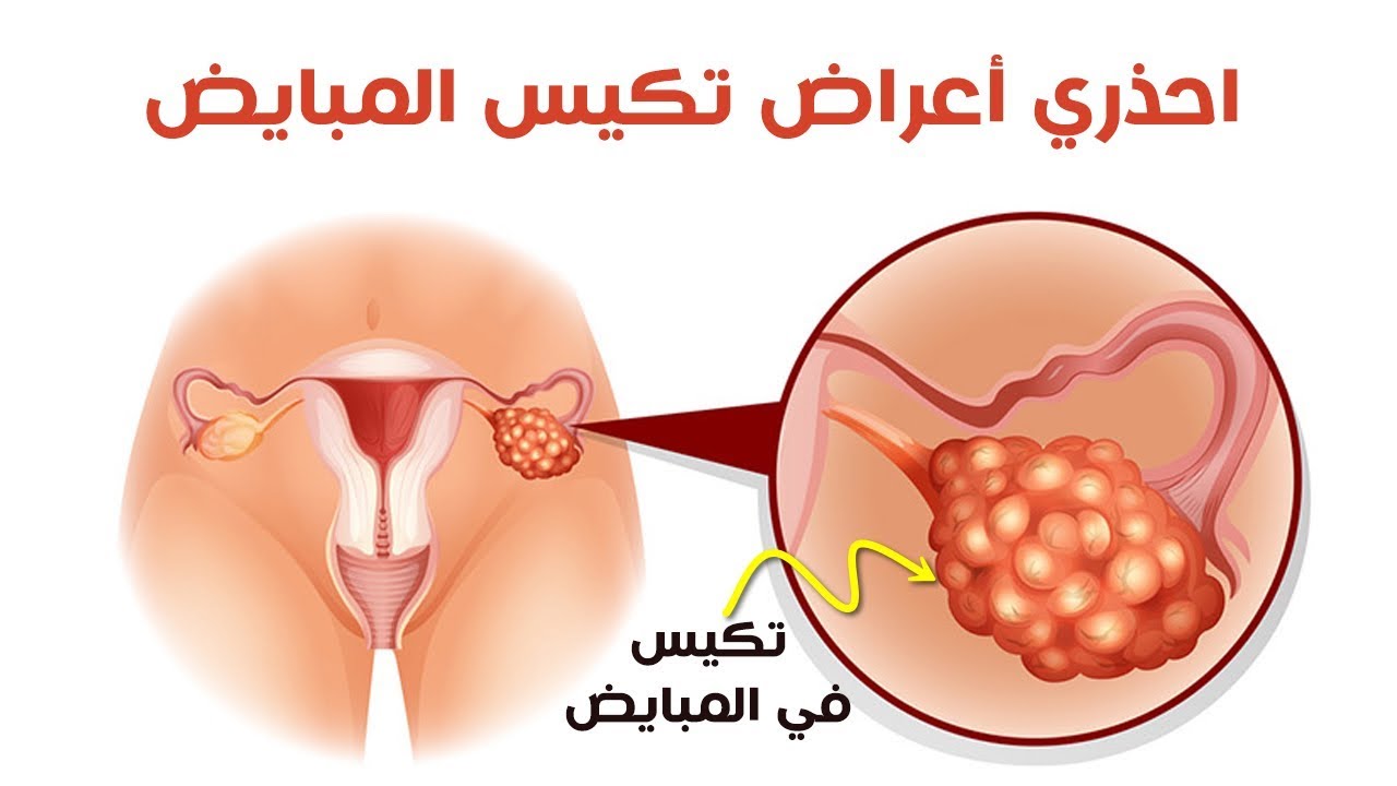 تكيسات المبايض- اعراض تكيس مبايض 1384 1