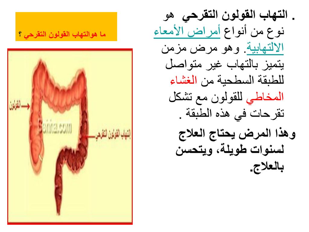 اعراض التهاب القولون التقرحي - مرض المعده والتهاب القولون واعراضهم 1298