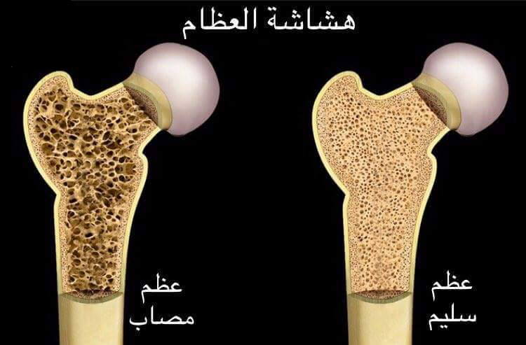 أهم أعراض وأسباب هشاشة العظام - اسباب هشاشة العظام 1485