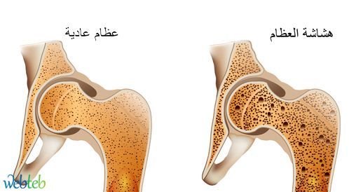 السبب فى هشاشه عظام الجسم - ماهي اسباب هشاشة العظام 3835