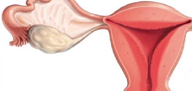 ماهي اسباب تكيس المبايض - اعراض تكيس المبايض 1959 1