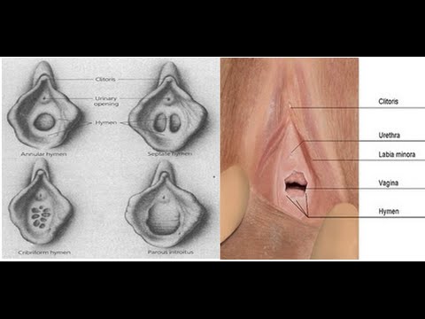 انواع غشاء البكارة - غشاء البكارة وتعدد انواعه 3677 1