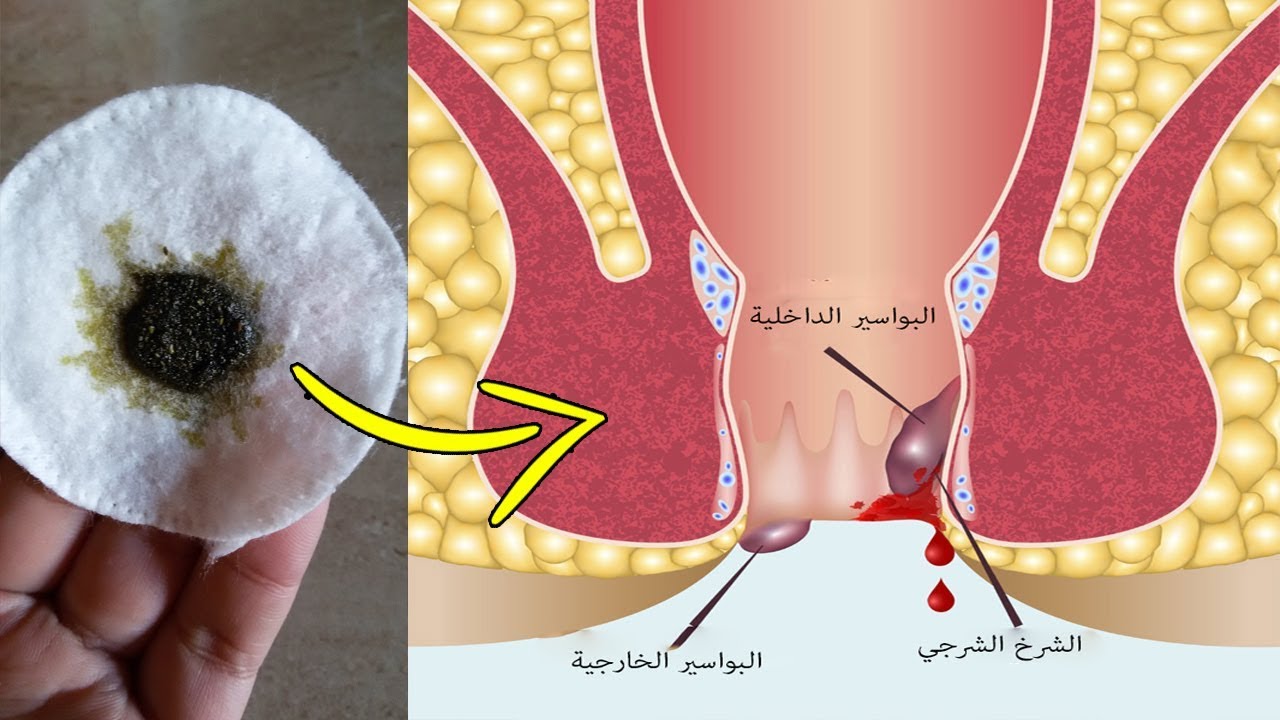 الفرق بين الشرخ والبواسير 2737 2