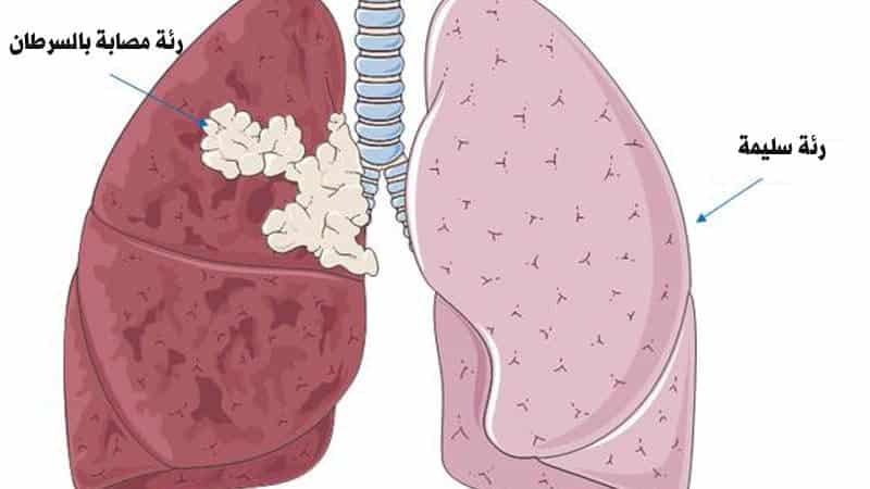 اعراض ورم الرئة الحميد , اصابه الرئه بالورم الحميد