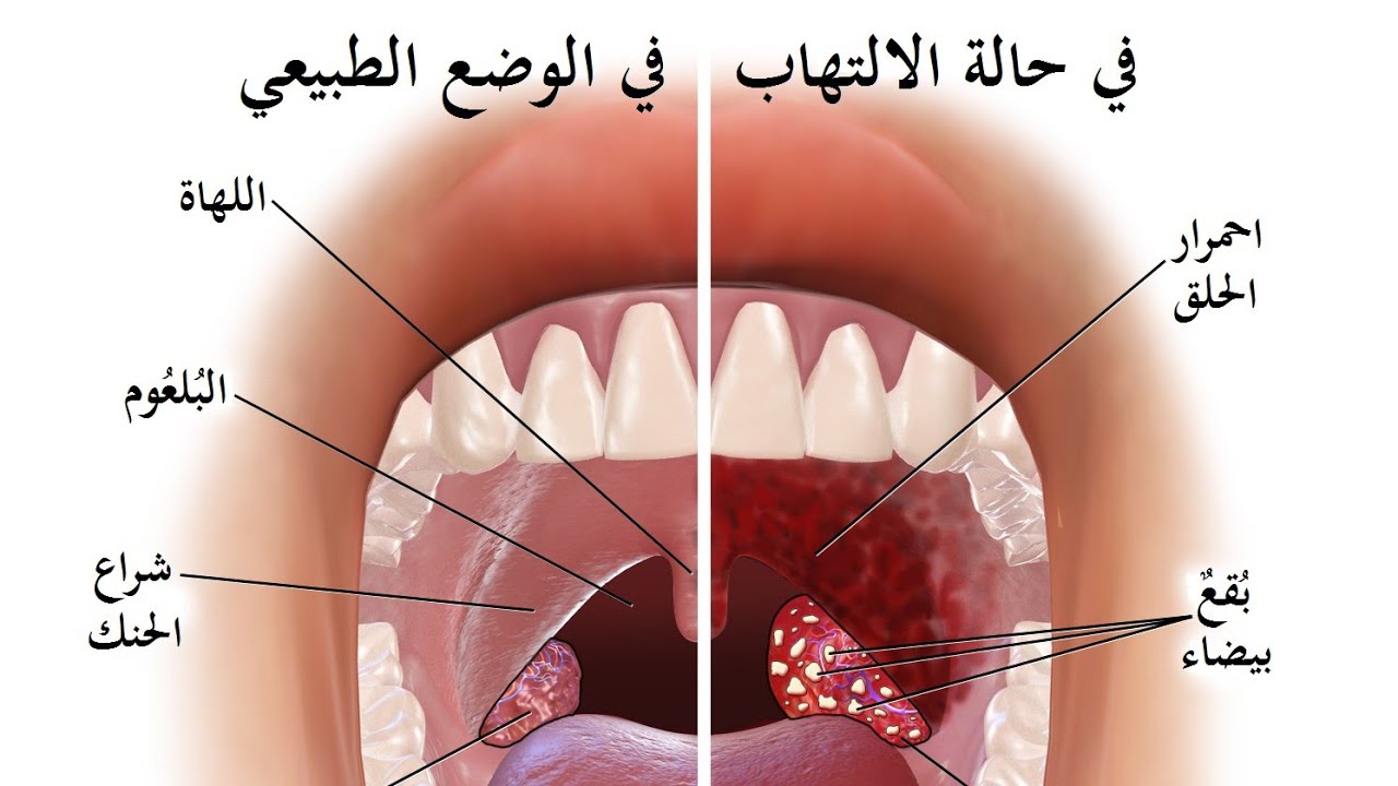 علاج التهاب الحلق والزكام , العلاج والوقايه من نزلات البرد