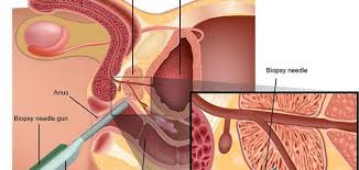 اعراض تضخم البروستاتا الخبيث , اورام البروستاتا وكل ما يجب معرفته عنها