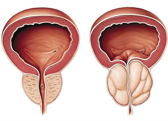 لمزيد من المعلومات الطبية تعرف على التهاب البروستاتا - الحجم الطبيعي للبروستاتا 791 1-Jpeg