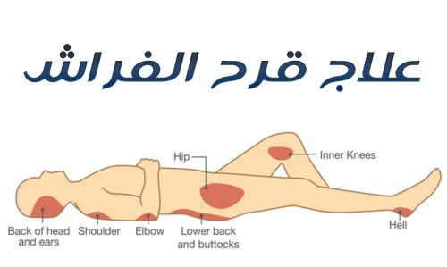 التخلص من هذا المرض , علاج قرح الفراش